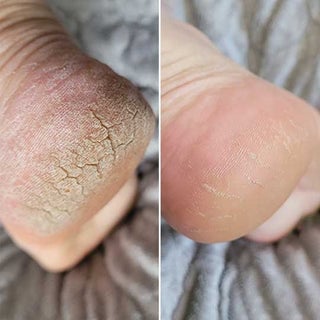 Antes y después - pies suaves (testimonio 1)