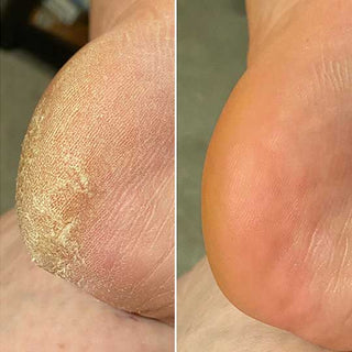 Antes y después - talones lisos (testimonio 3)