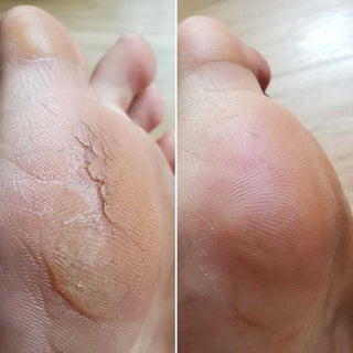 Antes y después - callos reducidos (testimonio 2)